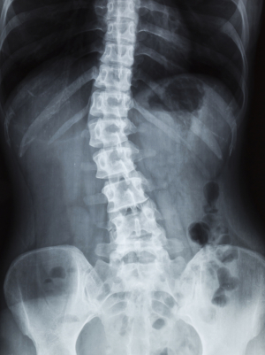 Scoliosis is a condition where the spine is curved from side to side