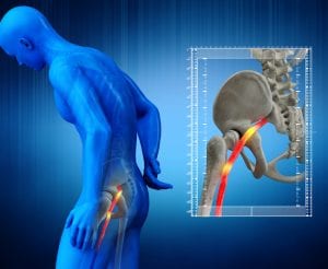 Sciatica: What it Is and How to Treat It
