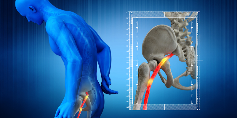 Sciatica: What it Is and How to Treat It